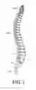 Fig. 02 - Spinal implants and implantation system