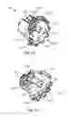 Fig. 31 - Humeral arthroplasty