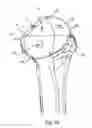 Fig. 66 - Humeral arthroplasty