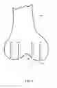 Fig. 06 - Low profile knee implant
