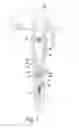 Fig. 08 - Prosthetic components and methods for joint line access