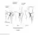 Fig. 02 - Ulnar Head Replacement Implant System