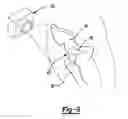 Fig. 06 - Method for implanting a hip prosthesis and related system