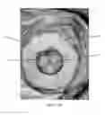 Fig. 46 - Articulated commissure valve stents and methods