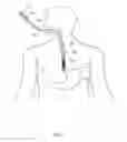 Fig. 02 - Delivery device for partially unconstrained endoprosthesis