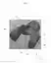 Fig. 07 - Void filling joint prosthesis and associated instruments