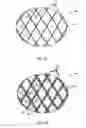 Fig. 04 - Esophageal stent