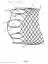 Fig. 06 - Esophageal stent