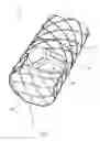 Fig. 09 - Esophageal stent