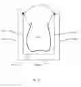 Fig. 06 - Customized dental impression tray