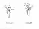 Fig. 07 - METHODS AND DEVICES FOR AFFECTING NERVE FUNCTION