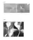 Fig. 02 - PREVENTION OF RECURRENCES OF URETHRAL STRICTURES FOLLOWING CONVENTIONAL THERAPY