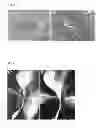 Fig. 03 - PREVENTION OF RECURRENCES OF URETHRAL STRICTURES FOLLOWING CONVENTIONAL THERAPY