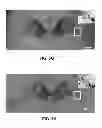 Fig. 06 - USE OF CYSTEAMINE IN TREATING PARKINSON'S DISEASE