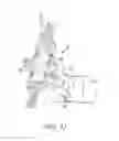 Fig. 33 - Surgical access system and related methods