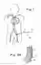 Fig. 02 - Devices, systems and methods for acute or chronic delivery of substances or apparatus to extravascular treatment sites