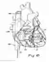 Fig. 08 - Devices, systems and methods for acute or chronic delivery of substances or apparatus to extravascular treatment sites