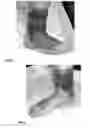 Fig. 03 - ANKLE-FOOT ORTHOSES