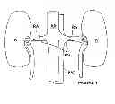 Fig. 02 - Methods for bilateral renal neuromodulation