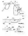Fig. 04 - Methods for bilateral renal neuromodulation
