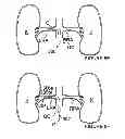Fig. 07 - Methods for bilateral renal neuromodulation