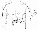Fig. 01 - Intragastric Volume Occupying Device with Active Agents