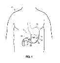 Fig. 02 - Intragastric Volume Occupying Device with Active Agents