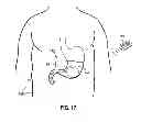 Fig. 11 - Intragastric Volume Occupying Device with Active Agents