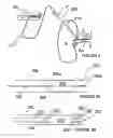 Fig. 04 - Methods for bilateral renal neuromodulation