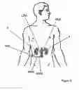 Fig. 11 - Methods for bilateral renal neuromodulation