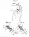 Fig. 02 - System and Method for Joint Resurface Repair