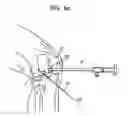 Fig. 08 - System and Method for Joint Resurface Repair