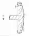 Fig. 89 - System and Method for Joint Resurface Repair