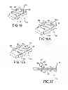 Fig. 14 - Vertebral joint implants and delivery tools