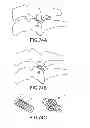 Fig. 65 - Vertebral joint implants and delivery tools