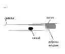 Fig. 03 - Non-lithotripsic kidney-stone therapy