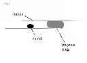 Fig. 04 - Non-lithotripsic kidney-stone therapy