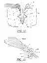 Fig. 07 - Anchor/suture used for medical procedures