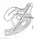 Fig. 33 - Methods for Anchoring Suture and Approximating Tissue