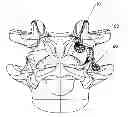 Fig. 01 - Facet fixation with anchor wire