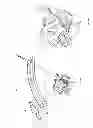 Fig. 03 - Facet fixation with anchor wire