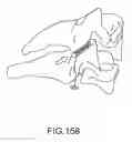 Fig. 131 - Vertebral joint implants and delivery tools