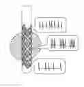 Fig. 01 - First time right placement of a DBS lead