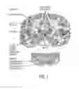 Fig. 02 - First time right placement of a DBS lead