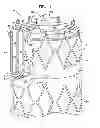 Fig. 02 - Triple-collar stent-graft