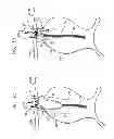 Fig. 06 - Triple-collar stent-graft