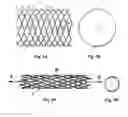 Fig. 02 - Bioabsorbable stents with reinforced filaments