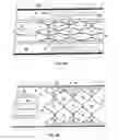 Fig. 04 - Bioabsorbable stents with reinforced filaments