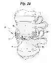 Fig. 09 - ANNULUS-REINFORCING BAND