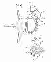 Fig. 10 - ANNULUS-REINFORCING BAND